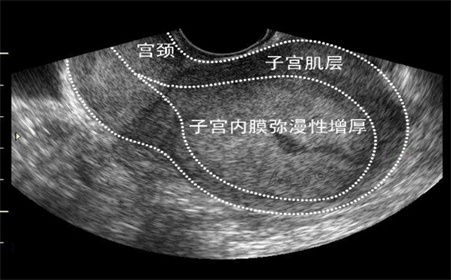 子宫肌炎患者赴美试管怀孕