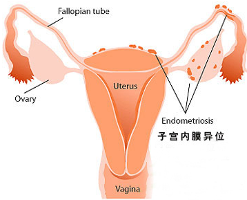 子宫内膜异位症会引起不孕吗