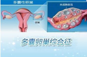 多囊卵巢综合症客人赴美试管怀孕